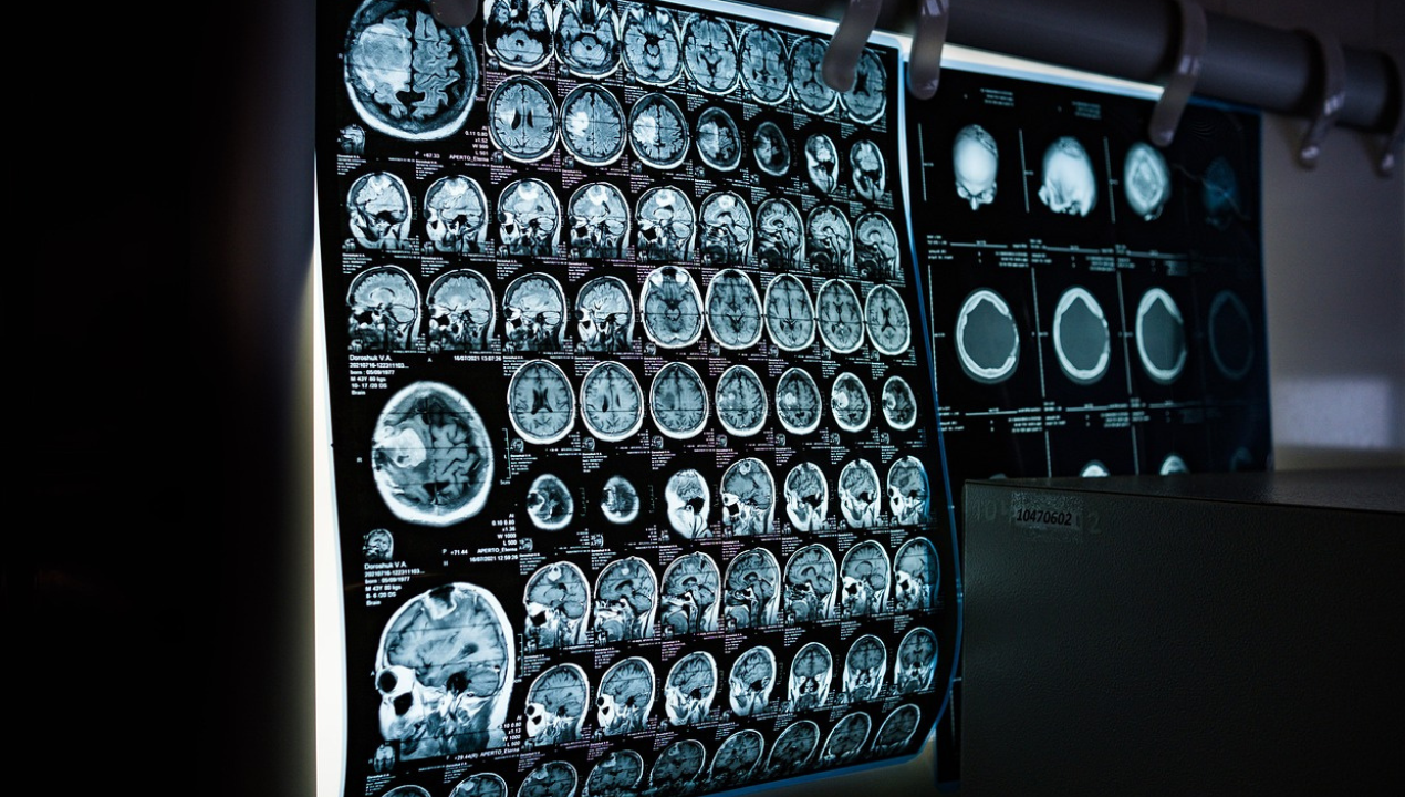 Traumatic Brain Injuries: Increasing Awareness